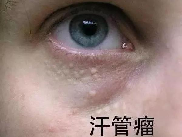 长了这么多年汗管瘤，你还以为是脂肪粒？