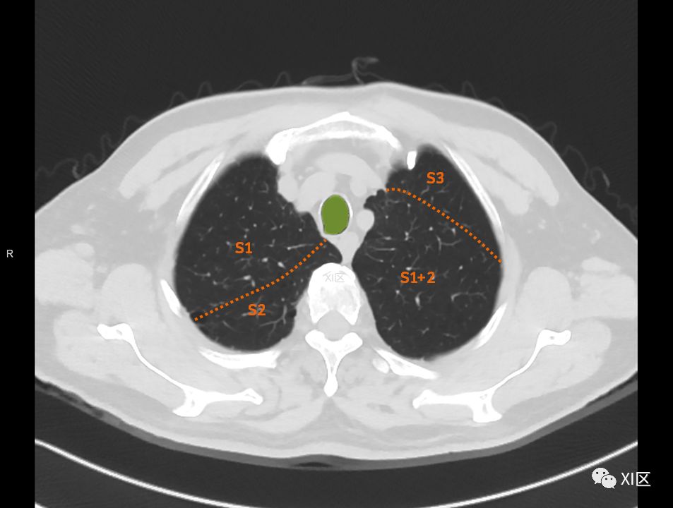 如此详细的肺部影像解剖，有点儿酷