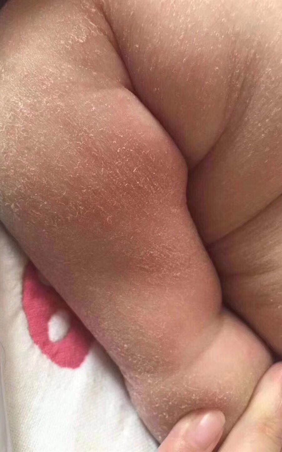 宝宝湿疹有多难分享治愈经验,经过实践的治疗宝宝湿疹方法大全