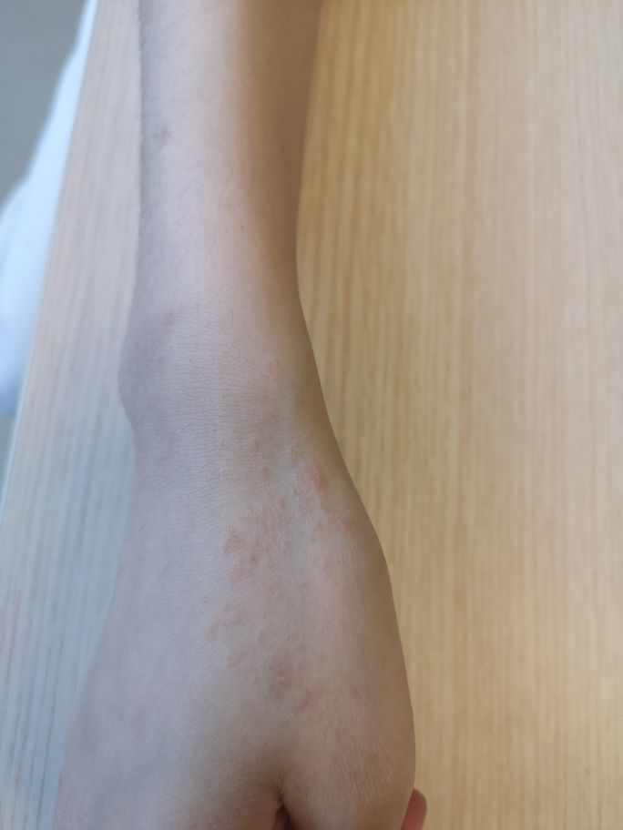 长成圆圈形状是癣还是湿疹,线状苔藓是什么原因造成的