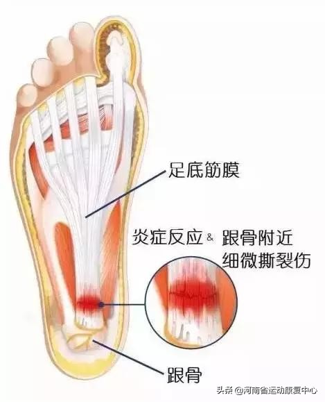足底筋膜炎的运动疗法是什么,足底筋膜炎的针灸疗法