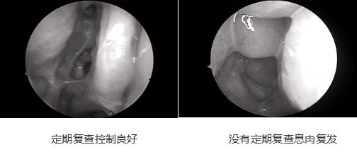 鼻窦炎鼻息肉做完手术还用复查吗,鼻息肉鼻窦炎多次复发怎么办