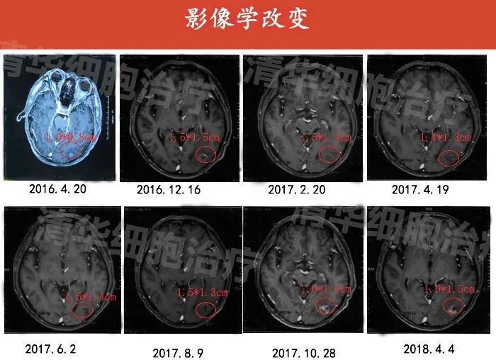 肺癌晚期活不了多久的症状,肺癌晚期生命只剩下六个月