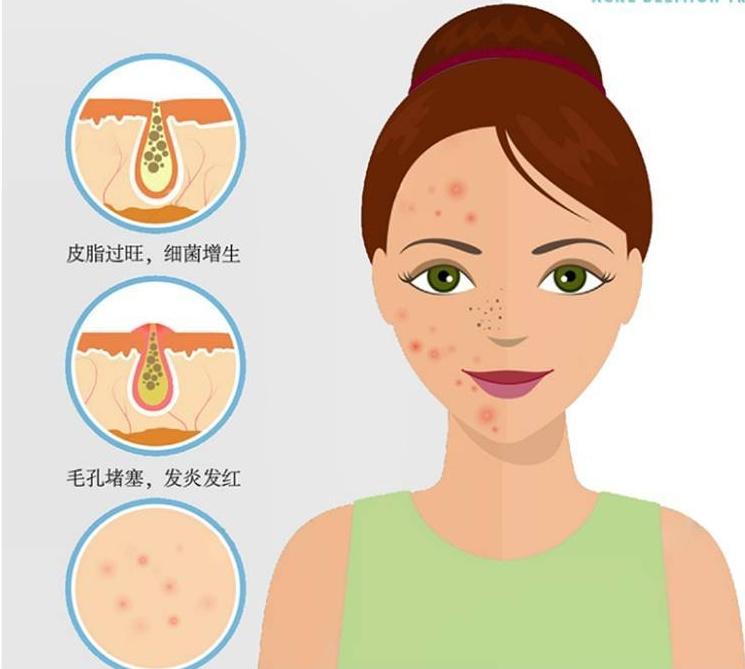 闭合性粉刺如何彻底根治,闭合性粉刺怎么才能根除