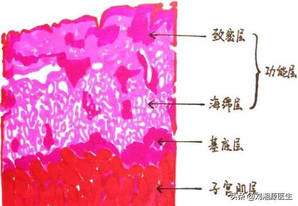 宫腔粘连合并妊娠,宫腔粘连容易导致生化妊娠吗
