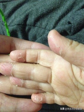 孩子的手总是脱皮,孩子的手总脱皮