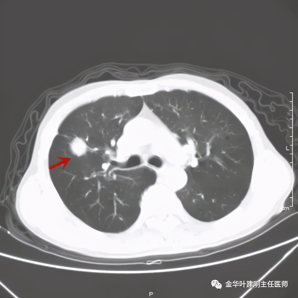 得了肺癌做肺部穿刺有影响吗,肺部穿刺可以确诊肺癌吗