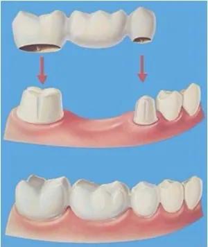 种植的假牙与真牙感觉一样吗,种植牙和假牙有什么区别吗