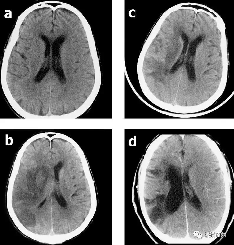 各部位脑梗死ct影像讲解,脑梗死ct影像最简单的是什么表现