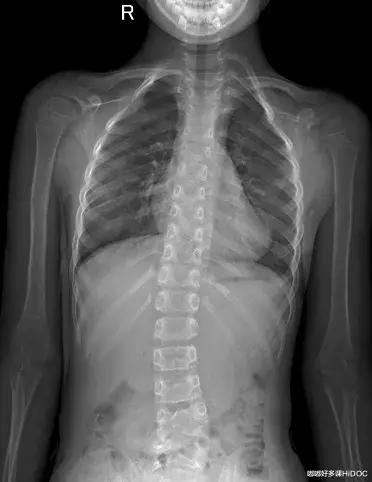 儿童颈椎侧弯会有什么后果,13岁孩子颈椎侧弯矫正睡姿图片