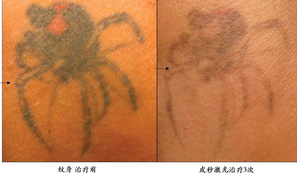 皮秒激光伤皮肤吗,皮秒激光能治凹陷疤痕吗