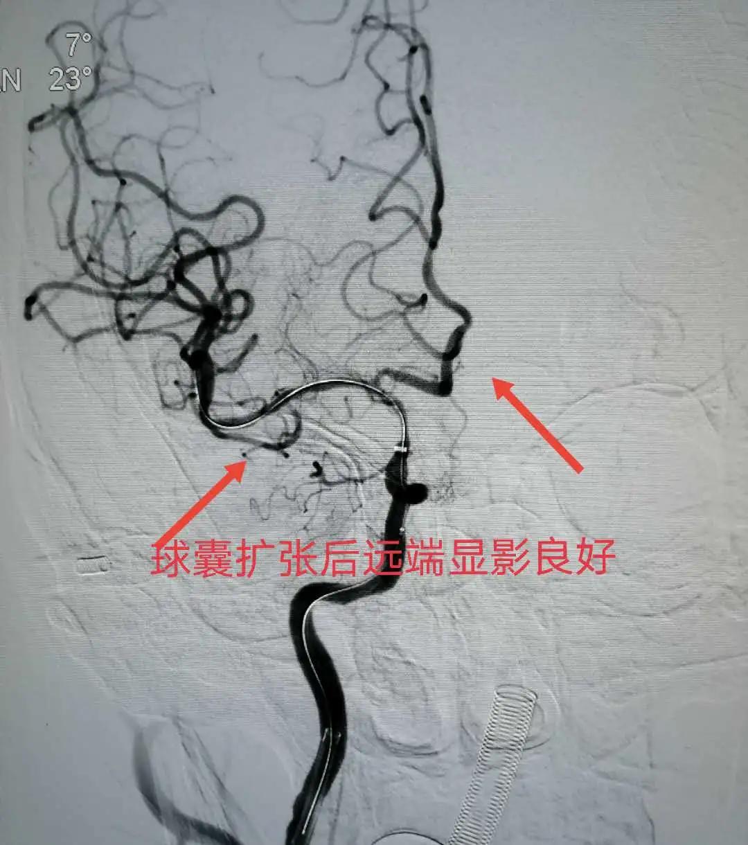 咸阳市最好的神经内科,咸阳市第一人民医院神经内科专家