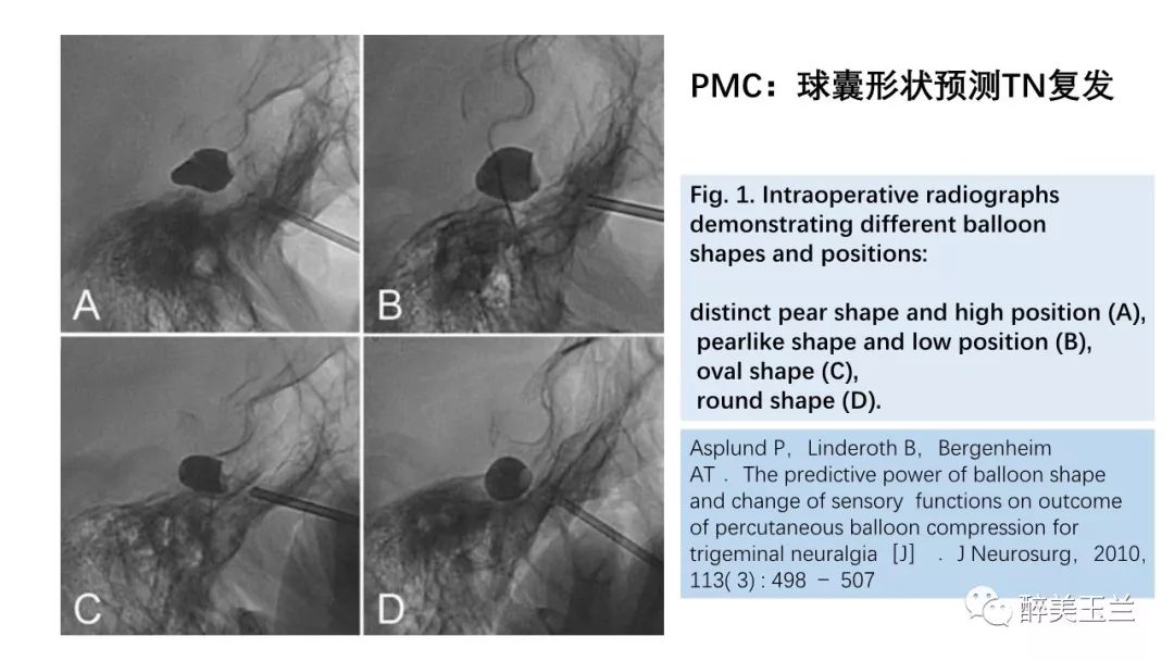 病例分享丨三叉神经节微球囊压迫术的麻醉管理