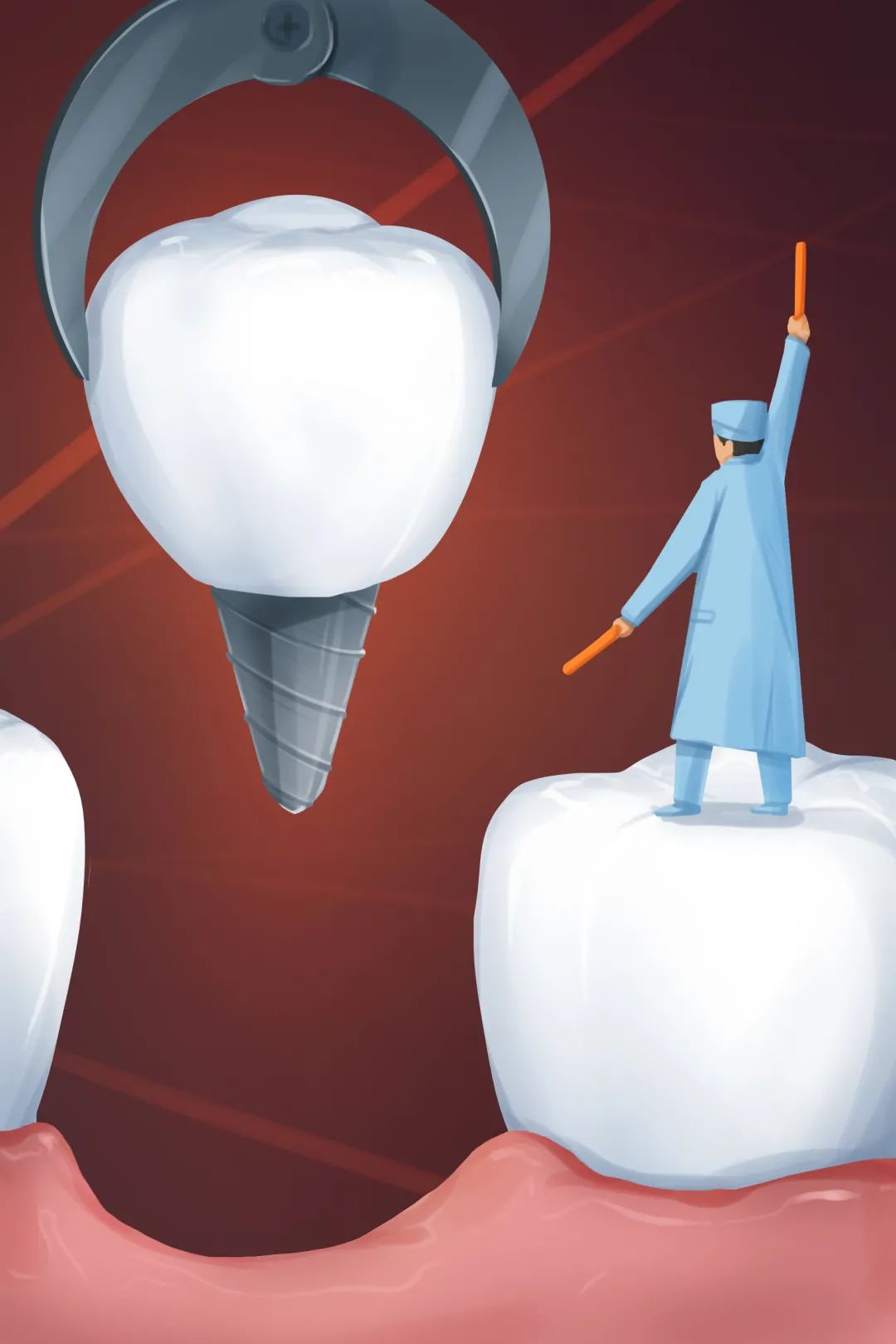 种植牙是不是要坏牙全拔,1颗牙坏了做牙套好还是种植牙好