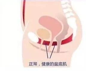 剖腹产盆底会松弛吗,剖腹产盆底就不会松了吗
