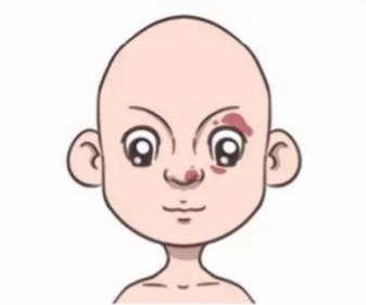 宝宝胎记的症状有哪些,宝宝出生有胎记是怎么来的