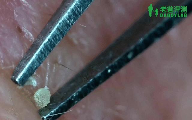 如何用简单的方法去黑头真实有效,别挤了教你去黑头的正确方法