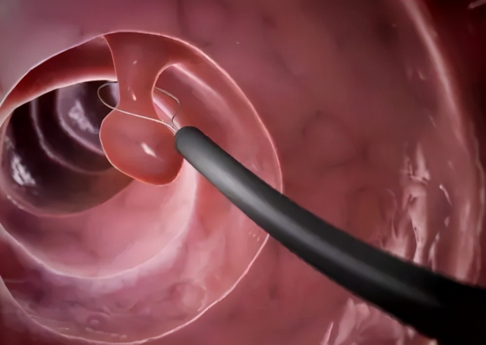 大便带血小腹痛挂什么科室,大便带血下腹疼痛