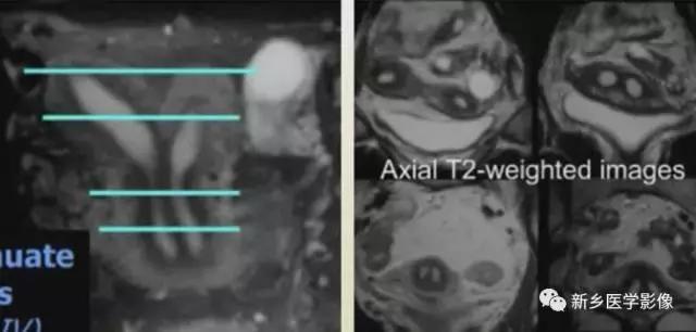 子宫发育异常，应想到的6大类常见畸形