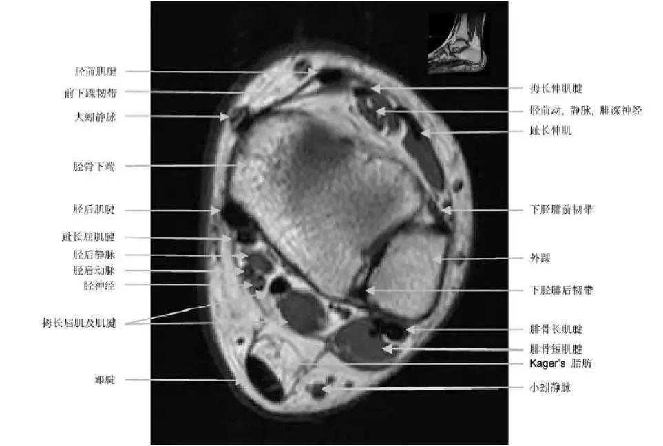 踝关节撞击症问诊,踝关节撞击综合征的x线表现