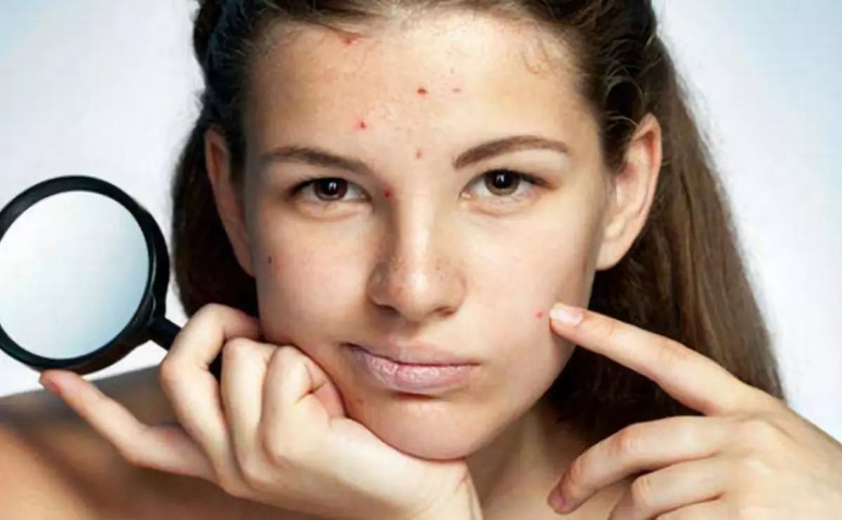 怎么有效祛除痘印痘坑小妙招,脸上有痘印痘坑怎么消除小妙招