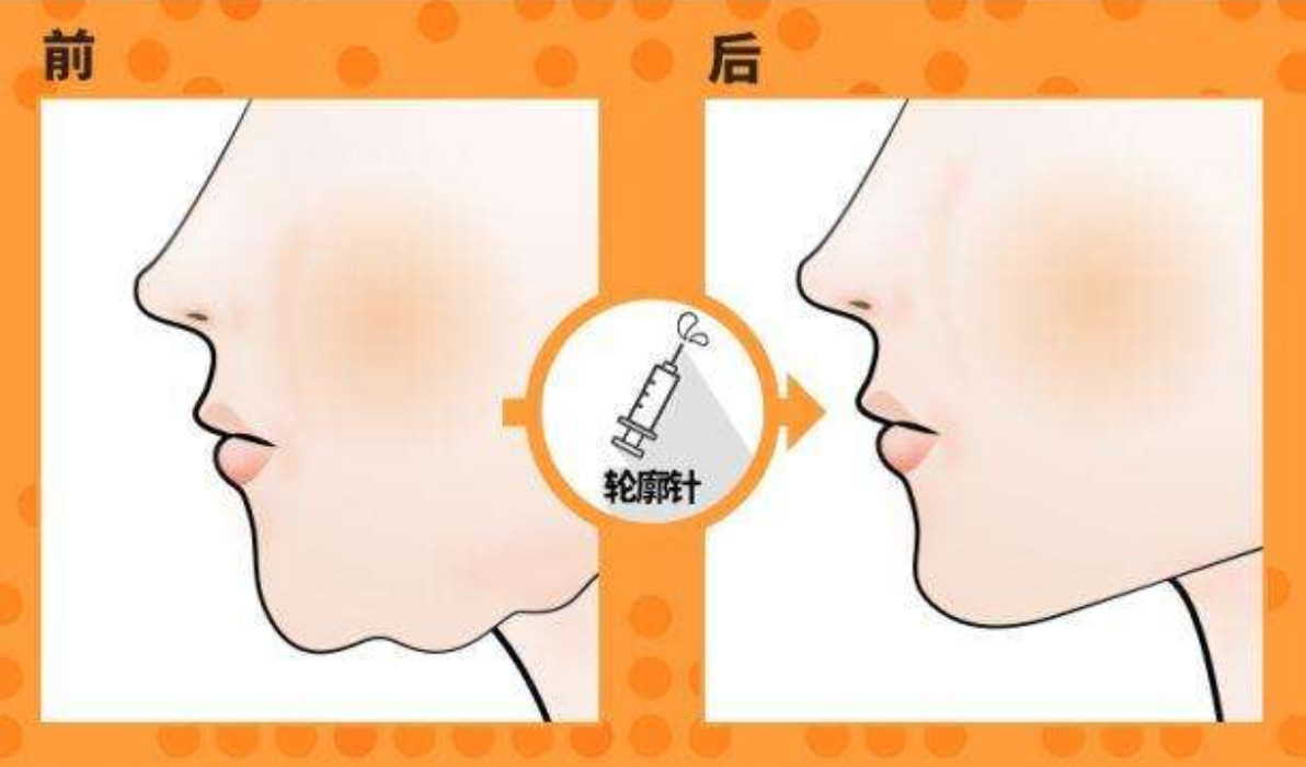 轮廓针和溶脂有什么区别,轮廓针和溶脂针哪个瘦脸效果好