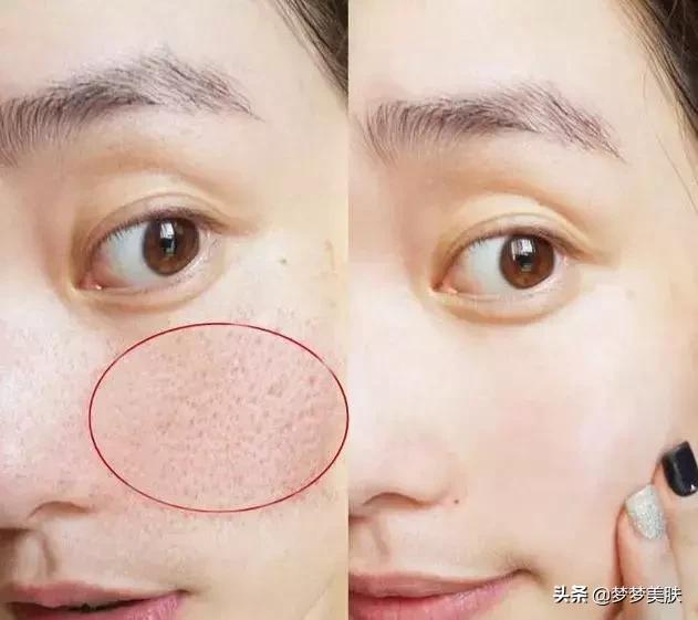 脸上毛孔粗怎么办简单收缩毛孔,女生毛孔大怎么收缩