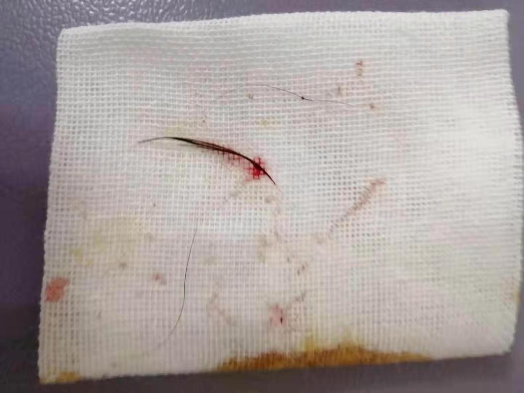 久坐屁股上长了一个脓包涂什么药,屁股上长了一个特大脓包