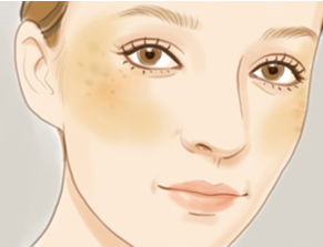 褐青色斑注意什么,褐斑应该注意什么