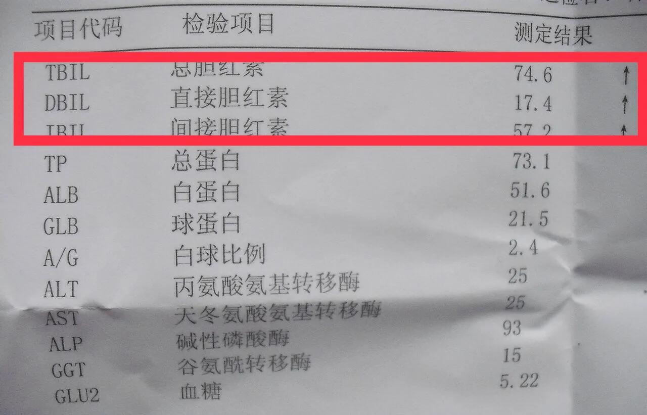 胆红素正常转氨酶高会是肝衰竭么,胆红素升高引发肝性脑病和黄疸