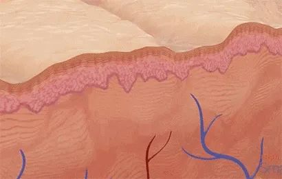 点阵激光治疗凹陷疤痕恢复过程,痤疮疤痕疙瘩可以激光治疗吗