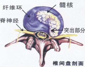 腰椎间盘膨出突出脱出有区别吗,腰椎间盘膨出和突出的中医治疗