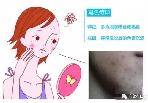 后背黑色痘印怎么消除,背部黑色痘印怎么消除