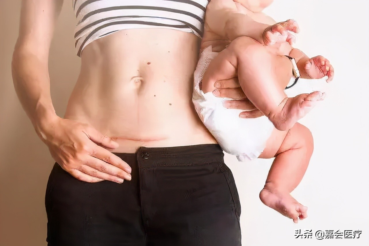 剖宫产和顺产哪个好得快,顺产与剖宫产如何选择