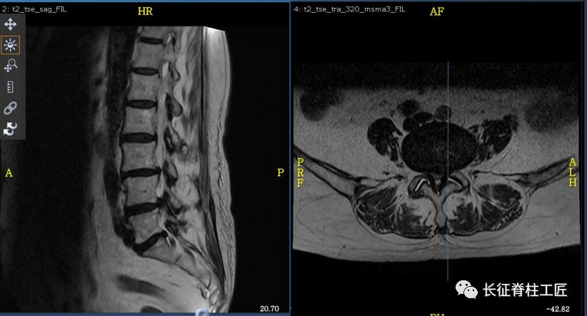 老年人腰椎管狭窄可以微创手术吗,老年人腰椎管狭窄瘫痪