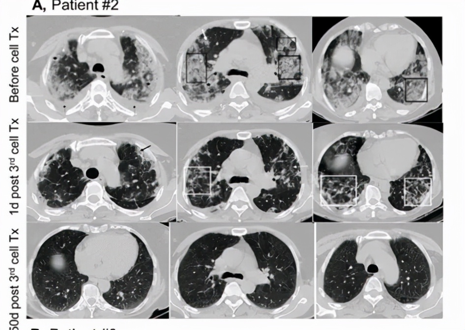 干细胞治疗新冠肺炎王福生,殷勤伟教授干细胞治疗新冠肺炎