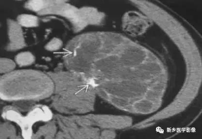 左肾可见高密度影不是结石,结节状高密度影是结石吗