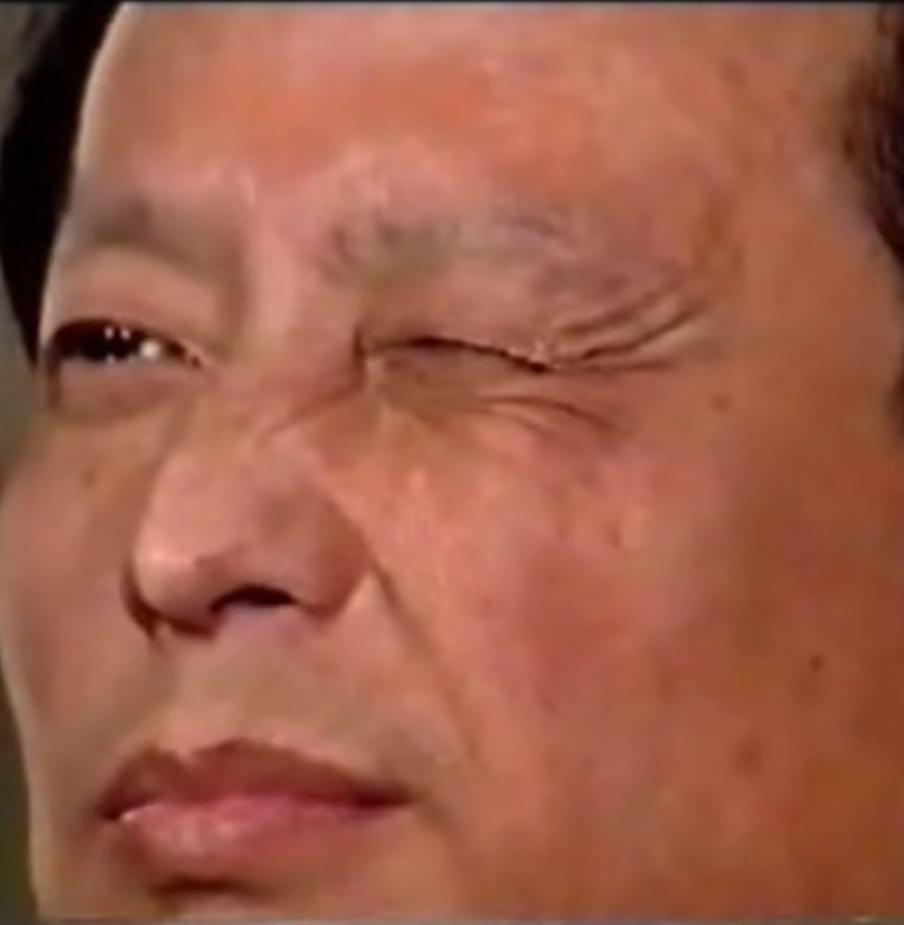 面神经炎治疗自述,面神经炎科普视频