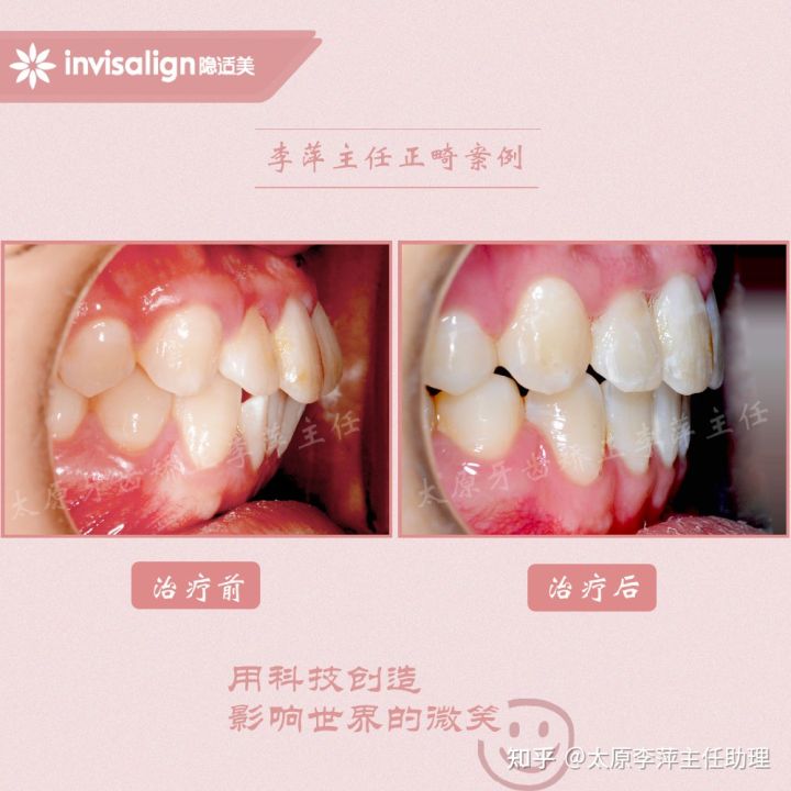 太原整牙齿矫正要多少钱,坏牙齿只剩牙根有必要拔牙吗