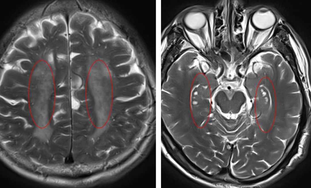 脑梗溶栓后脑出血脑疝晚期,阿替普酶溶栓后脑出血处理