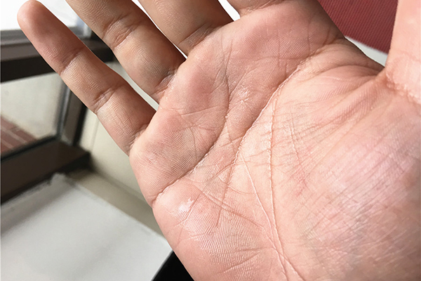 手上起的小水泡是汗疱疹还是湿疹,手上起小水泡很痒是湿疹还是过敏