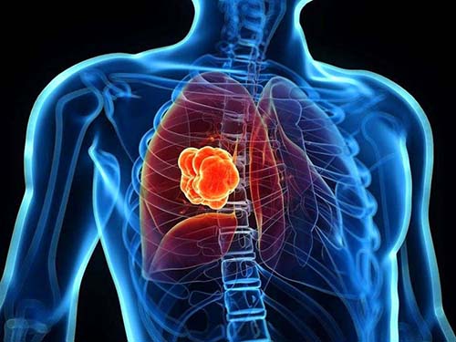 肺癌的中医辨证分型,肺癌各分型治疗方案