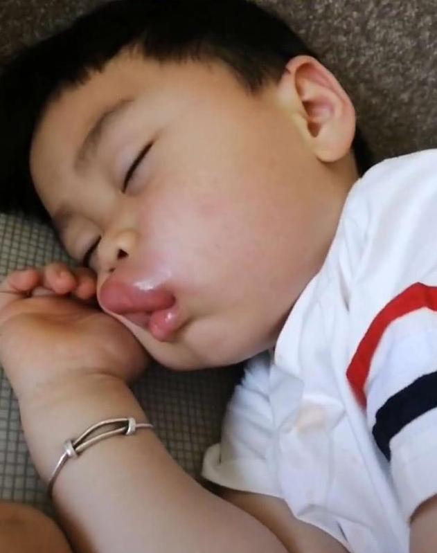 4岁小孩嘴巴突然肿成香肠嘴原因,孩子嘴巴肿得像香肠