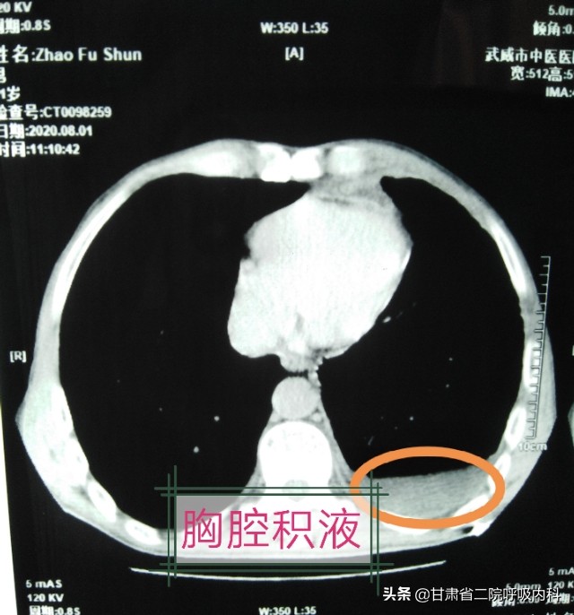 老人咳嗽胸腔积液怎么消除和恢复,老年人反复胸腔积液怎么回事