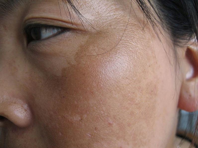 怎么区分脸上是什么斑,脸上斑怎么区分