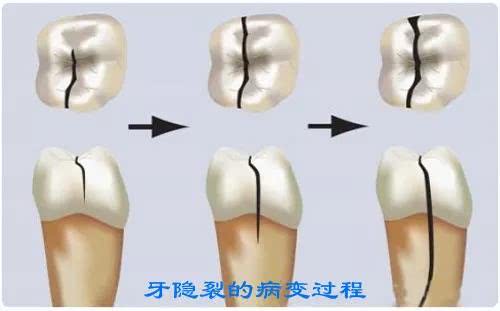 牙齿靠近牙龈的地方烂出一条缝,牙齿裂开了一条缝怎么修复多少钱