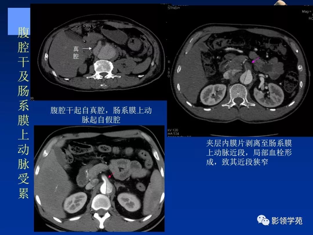 主动脉夹层壁间血肿如何鉴别,主动脉夹层血肿溃疡