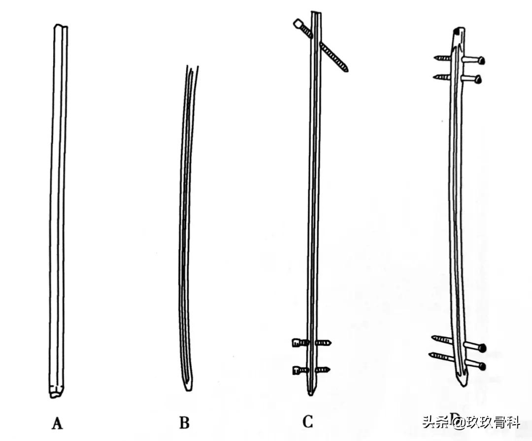 骨科取髓内钉的视频,骨科髓内钉内固定术式简写