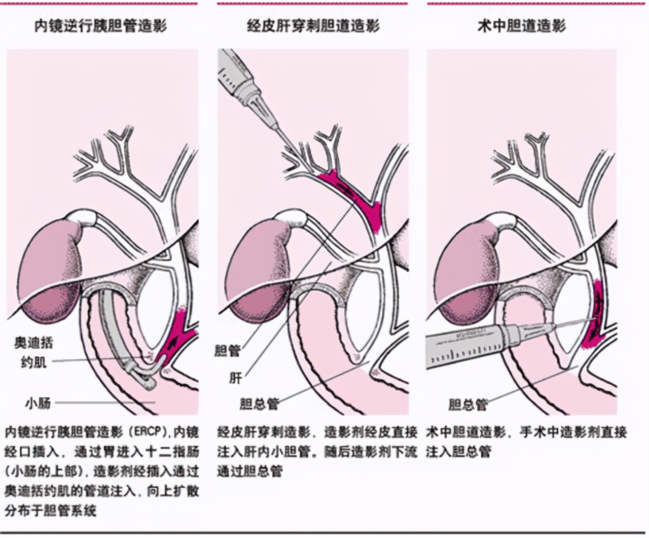 胆囊炎引起胃痛怎么治疗好得快呢,胆囊炎引起的胃痛怎样缓解呢