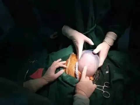 刚刚生出来的宝宝奇怪现象,妈妈生下孩子后难产大出血